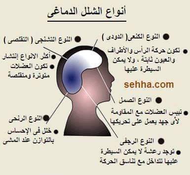 أنواع الشلل الدماغي