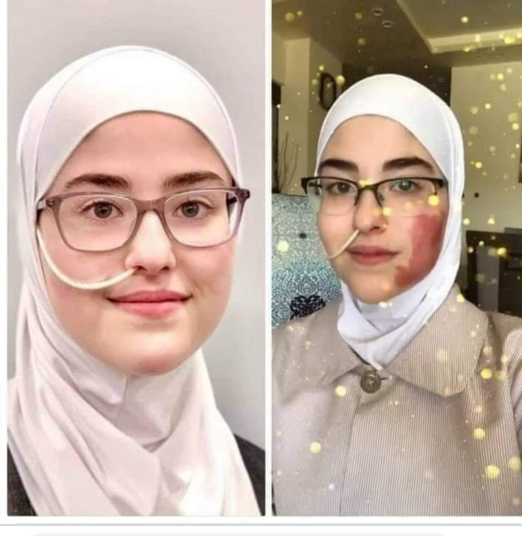 كل ما تريد معرفته عن متلازمة إهلر - دانلوس