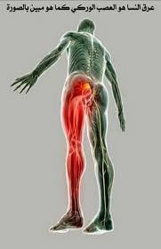 طرق الوقاية من الإصابة بـ عرق النسا .. الأسباب والأعراض والعلاج